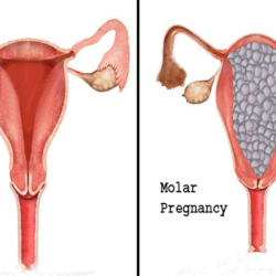 mol-gebelik-nedir,-belirtileri-nelerdir?