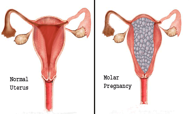 mol-gebelik-nedir,-belirtileri-nelerdir?